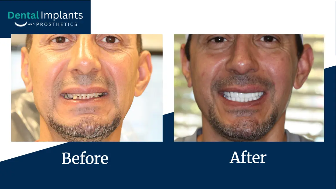 Before-and-after photos showing a patient’s dental implant results