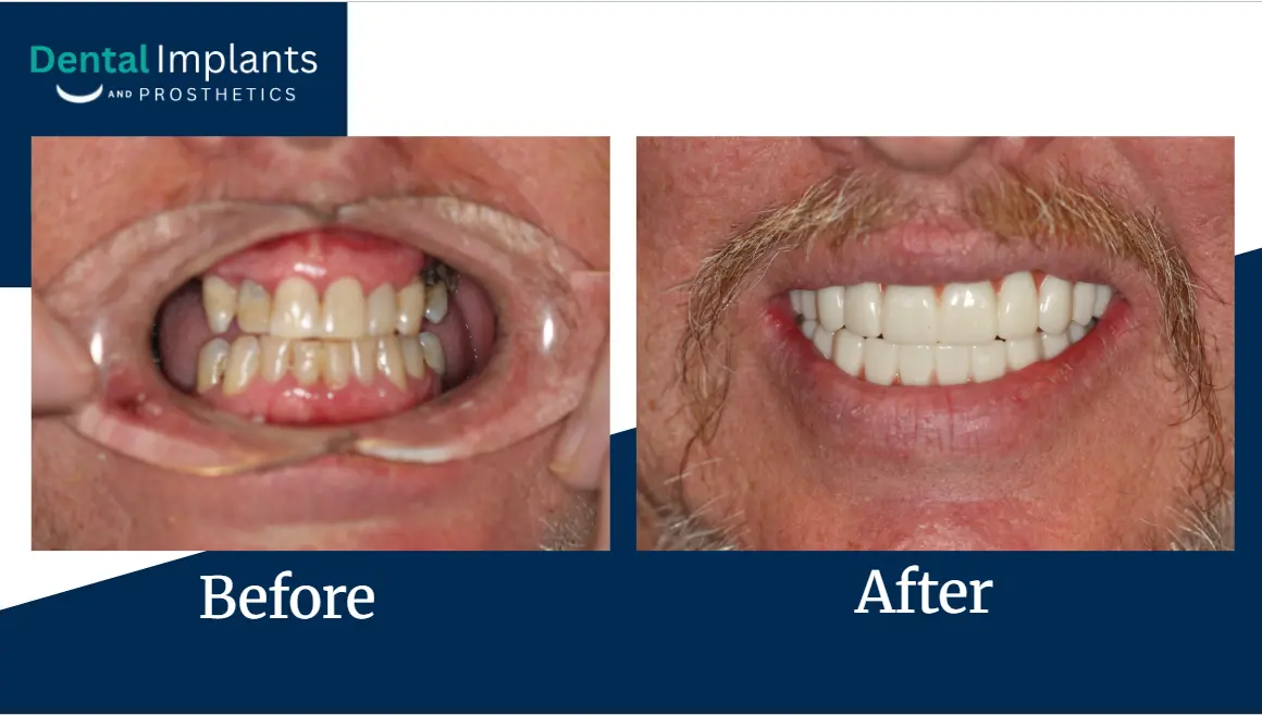 Before-and-after dental implant restoration results showing a patient’s smile improvement