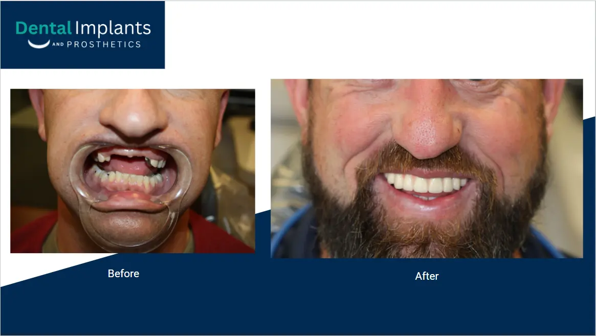 Before-and-after photo of a man showing dental restoration results
