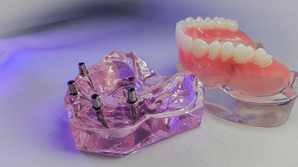 Dental models showing implant-supported dentures with visible screws