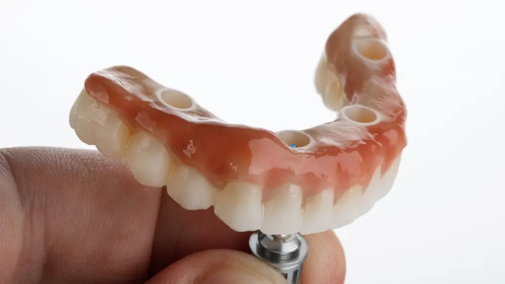 How Long Do Implant Dentures Last?
