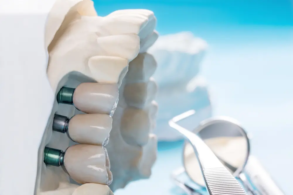 Dentulous model cast with dental implants and treatment tools